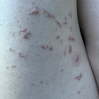 LaserAway - The first bit of blistering - Tattoo Removal Near Me - Houston, Texas