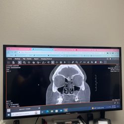 Sinus Relief Center - My CT scan, everything that is grey around my nose was infection