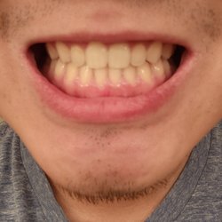Szymanowski Orthodontics - After, trust me the difference is huge