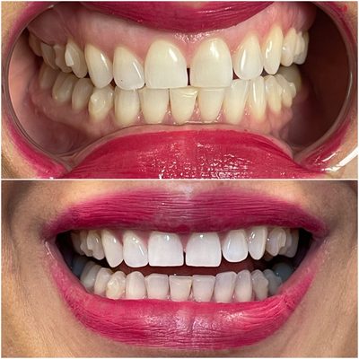 From Yellow to White in under an hour! - Needing your teeth whitened, but don't want to go through the stress and mess of going to a dentists office, just to have them poke and prod your teeth, ultimately for the same result? That is now a thing of the past! Over the past few years I have created a professional and certified safe model to transform your smile in the easiest and most direct way possible!