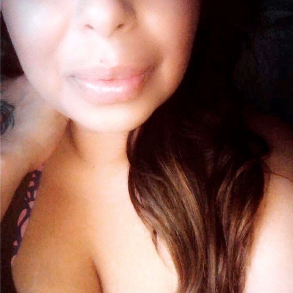 Ego - 2 syringes 1 year later - Body Contouring Near Me - Modesto, California