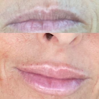 Party With Botox - Before & After - Skin Care Near Me - Newport Beach, California
