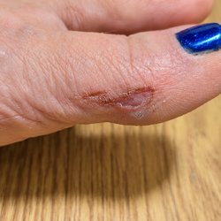 Glitzy Nails - Broken skin that was scrubbed to aggressively