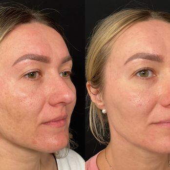 Angell Medical Spa - Before and after treatment. just one month apart. - Medical Spas Near Me - Sacramento, California Angell Medical Spa - Before and after treatment. just one month apart. - Medical Spas Near Me - Sacramento, California