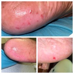 Precious 1 Nail - Bottom of my feet