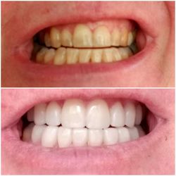 Top - before. Bottom - veneers on