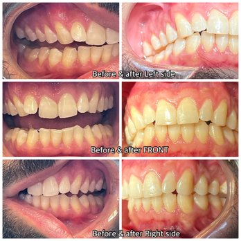 Family Crown Dentistry - Invisalign after eight months! - General Dentistry Near Me - Dearborn, Michigan Family Crown Dentistry - Invisalign after eight months! - General Dentistry Near Me - Dearborn, Michigan