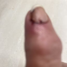 Right hand index finger three months after initial nail infection