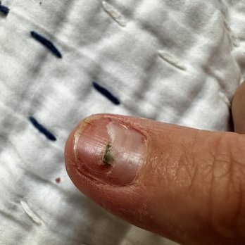 Femimacus Nails - Damaged/injured fingernail after acrylics removal - Nail Salons Near Me - Oakland, California Femimacus Nails - Damaged/injured fingernail after acrylics removal - Nail Salons Near Me - Oakland, California