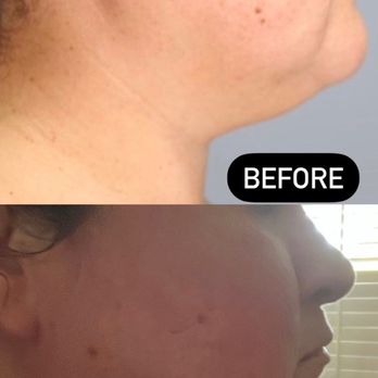 Rockstar Beauty - Chin lipo results - Medical Spas Near Me - Beverly Hills, California Rockstar Beauty - Chin lipo results - Medical Spas Near Me - Beverly Hills, California