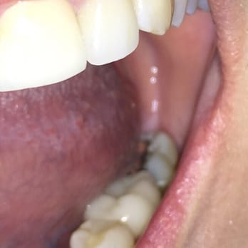 John T Smaha, DDS - second bottom tooth from the back (#17?) has a new crown. It used to look like #18 with a large silver filling. Yay Dr. Smaha! - General Dentistry Near Me - San Jose, California John T Smaha, DDS - second bottom tooth from the back (#17?) has a new crown. It used to look like #18 with a large silver filling. Yay Dr. Smaha! - General Dentistry Near Me - San Jose, California