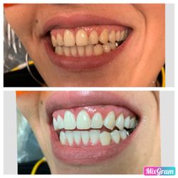 19th Ave Dental Care - Teeth Whitening completed in less than 1 1/2 hours. What a hugeeee difference!!!