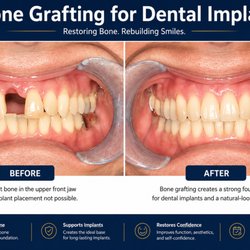 Bone Grafting for Dental Implants