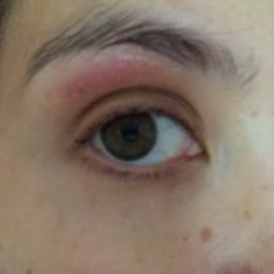Hythe Beauty Centre - Nasty red sore graze on my upper eyelid after terrible waxing experience