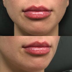 Studio R Aesthetics - 1 syringe of Kysse Lip Filler