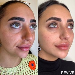 Revive Medical Botox and Laser - Full face refresher
