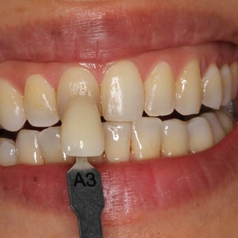 Michael Nazarian, DDS - before zoom 7/3/2014 - General Dentistry Near Me - Los Angeles, California Michael Nazarian, DDS - before zoom 7/3/2014 - General Dentistry Near Me - Los Angeles, California