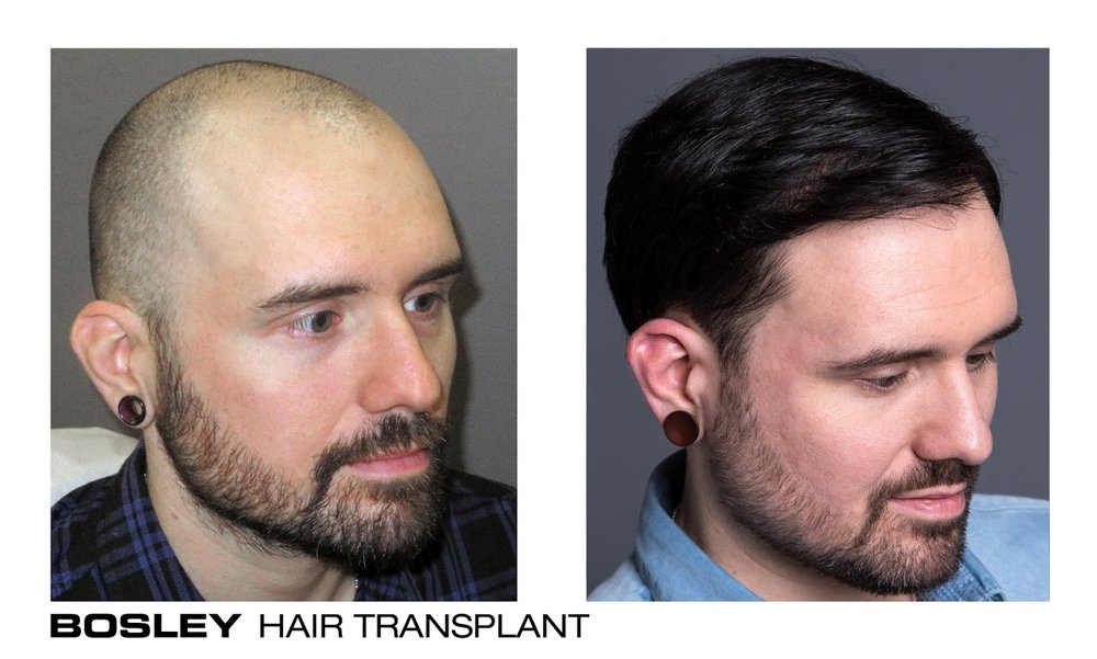 Bosley Hair Transplant Restoration 47 Photos Hair Loss
