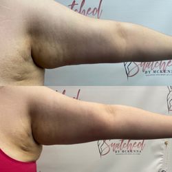 Snatched By Mckenna - Lipo cavitation One Session on Arms