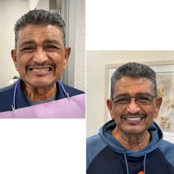 Oak Tree Dentistry - All on 4 implants fixed teeth