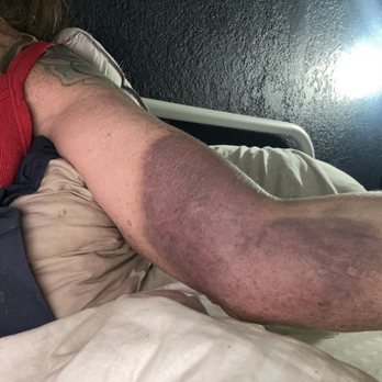 CSL Plasma - Back side of my arm 5 days after - Blood & Plasma Donation Centers Near Me - Mesquite, Texas CSL Plasma - Back side of my arm 5 days after - Blood & Plasma Donation Centers Near Me - Mesquite, Texas