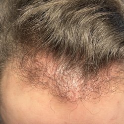 Bosley Hair Restoration & Transplant - 5 months and 17 days from second transplant