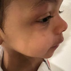 Top Kids Bilingual Preschool - Bruised eye, with 2 bruises on the side of his face.