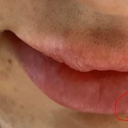 Lip filler