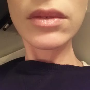 Project Skin, MD - 5days after lip injection. I my perfectly symmetrical lips! - Medical Spas Near Me - Vancouver, British Columbia Project Skin, MD - 5days after lip injection. I my perfectly symmetrical lips! - Medical Spas Near Me - Vancouver, British Columbia