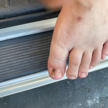 Robert Joseph, DPM - 2nd follow up, 2 weeks post-op, made sure everything was healing right! - Podiatrists Near Me - Tustin, California Robert Joseph, DPM - 2nd follow up, 2 weeks post-op, made sure everything was healing right! - Podiatrists Near Me - Tustin, California