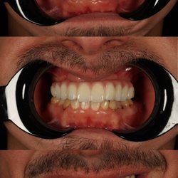 Paradise Valley Dental - All on X aka Implant Supported Denture: Restore form, function, and esthetics with an implant supported solution!