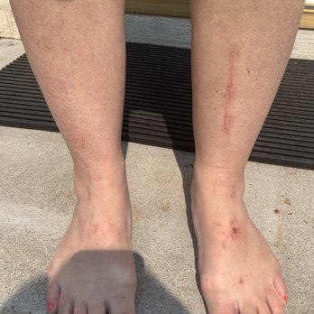 Elegant Nails & Spa - The scars the next day from going here!! She used a pumice stone on her legs - Nail Salons Near Me - Goleta, California Elegant Nails & Spa - The scars the next day from going here!! She used a pumice stone on her legs - Nail Salons Near Me - Goleta, California