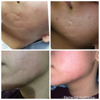 Elemental Aesthetics - Deep Sea non chemical peel
Top: Before
Bottom: After 1 peel
Unbelievable transformation in her scar depth and smoothness - Skin Care Near Me - Mahopac, New York Elemental Aesthetics - Deep Sea non chemical peel
Top: Before
Bottom: After 1 peel
Unbelievable transformation in her scar depth and smoothness - Skin Care Near Me - Mahopac, New York