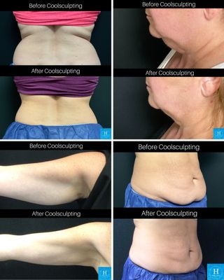 Coolsculpting - ❄️ CoolSculpting Treatments at Healthy Solutions Medspa

Freeze away stubborn fat safely and effectively with CoolSculpting at Healthy Solutions Medspa, a premier aesthetic practice recognized in the top Coolsculpting provider nationwide and #1 Coolsculpting provider in Bucks County, PA and the surrounding region.

Our experienced team of medical professionals specialize in non-surgical body contouring treatments designed to sculpt, tone, and redefine your shape with no surgery, no needles, and little to no downtime.

Using FDA-cleared CoolSculpting technology, we target and eliminate fat cells that resist diet and exercise, helping you achieve natural-looking, long-lasting results you’ll love.

Healthy Solutions Medspa proudly serves patients from two convenient locations in Furlong and Ivyland, Pennsylvania, offering a full range of non-surgical treatments for facial rejuvenation, skin health, weight loss, and body contouring.

✨ Why patients love us:
Top Coolsculpting provider in the U.S., Bucks County, PA and the surrounding Philadelphia region.
Certified CoolSculpting specialists
Personalized treatment plans and body assessments

Proven, natural-looking results with no downtime
📍 Locations:
Ivyland, PA
Furlong, PA

❄️ Book your CoolSculpting consultation today and discover why Healthy Solutions Medspa is Bucks County’s trusted destination for body contouring and aesthetic excellence.