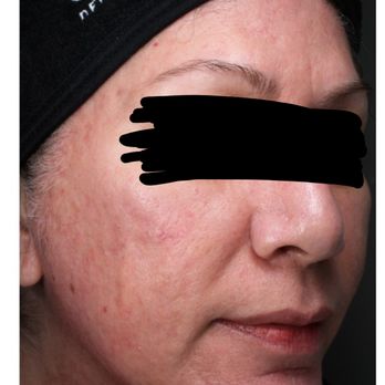 Bespoke Dermatology & Aesthetics - This was taken before my latest treatment. My skin gets better with each treatment, which is why I'll be Dr. Ho's patient for life. - Dermatologists Near Me - Arcadia, California Bespoke Dermatology & Aesthetics - This was taken before my latest treatment. My skin gets better with each treatment, which is why I'll be Dr. Ho's patient for life. - Dermatologists Near Me - Arcadia, California