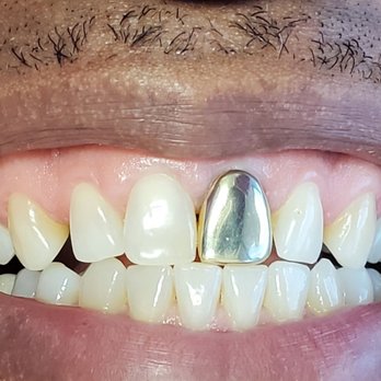 Simply Crowns - General Dentistry Near Me - San Antonio, Texas Simply Crowns - General Dentistry Near Me - San Antonio, Texas