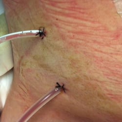 David T. Wong, MD - Drain tubes sewn into my abdomen after Wong almost killed me. My life has never been the same. Stay away from this Dr!