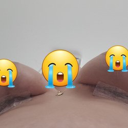 Hongshik Han MD - Because the left one is not inserted properly, my breast are completely uneven. This is 2 weeks post op.