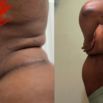 Zion Plastic Surgery - 1st picture is the day of surgery the second picture is three months post op - Cosmetic Surgeons Near Me - Miami, Florida