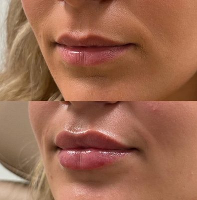 Lip Fillers - Mention Yelp for $50 off your first appointment with us! Book online today or call with any questions. Lip Fillers - Mention Yelp for $50 off your first appointment with us! Book online today or call with any questions.