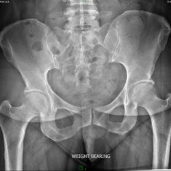Dean Wang, MD - Left hip upward tilt