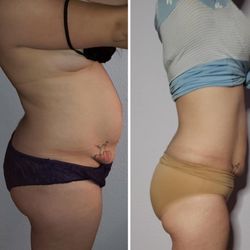 MaryAnn's Aromatherapy And Wellness - 10 Cryoskin Slimming Sessions Results
