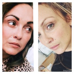 Effortless Beauty Studio - Botox & 1 ML lip injection