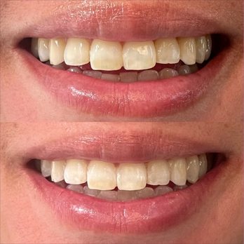 HySmiles - Teeth Whitening Near Me - San Jose, California HySmiles - Teeth Whitening Near Me - San Jose, California