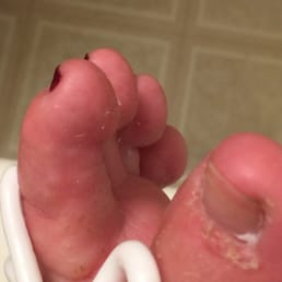 Beginning stages of rash and infection from pedicure... Beginning stages of rash and infection from pedicure...
