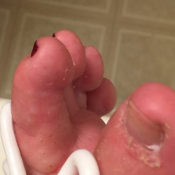 Rose Nail & Spa - Beginning stages of rash and infection from pedicure... - Nail Salons Near Me - San Antonio, Texas Rose Nail & Spa - Beginning stages of rash and infection from pedicure... - Nail Salons Near Me - San Antonio, Texas