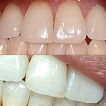 Man Dental - Before Picture - General Dentistry Near Me - West Covina, California