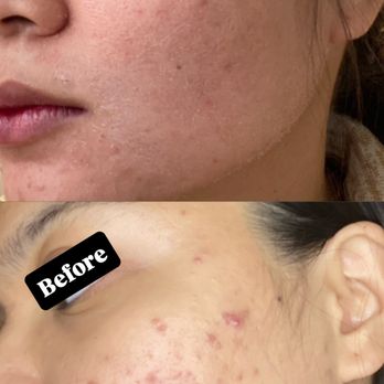Skin By Wave - Advanced Acne Treatment - Estheticians Near Me - Cypress, California Skin By Wave - Advanced Acne Treatment - Estheticians Near Me - Cypress, California