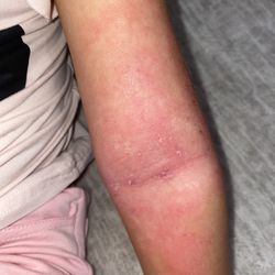 Happy Skin Pediatric Dermatology - Before