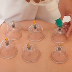 Hofman Chiropractic and Wellness - Myofascial decompression using the cupping method is a great way that Hofman Chiropractic can get oxygenated blood to overworked areas